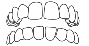 空隙歯列（すきっ歯）イラスト